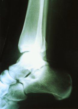 X-ray of right ankle