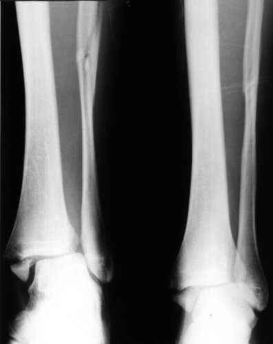 X-ray of right ankle